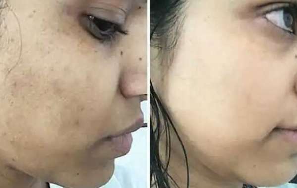 How to get rid of dark spots on the skin