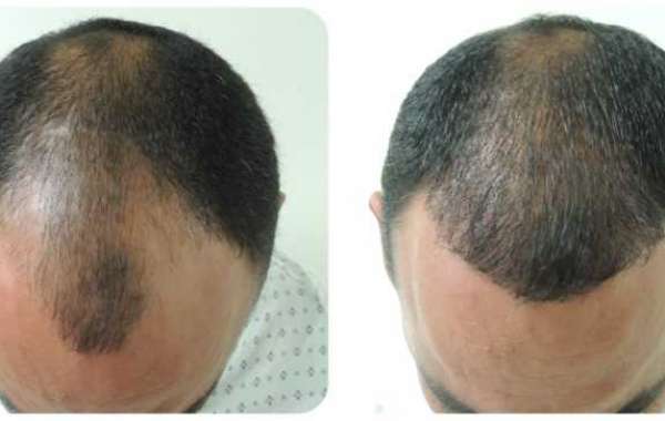 Cuanto Cuesta Un Trasplante de Cabello