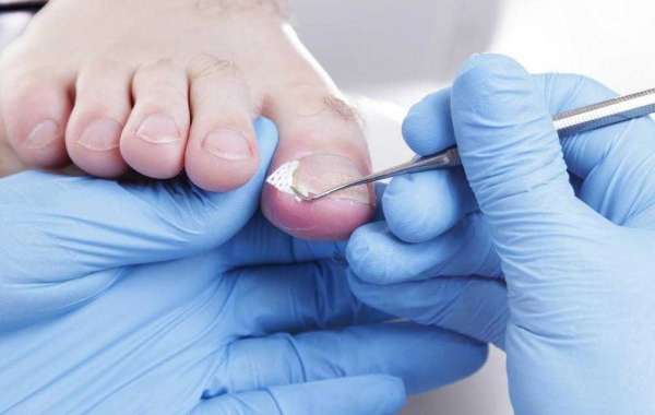 Ingrown Toenail Urgent Care