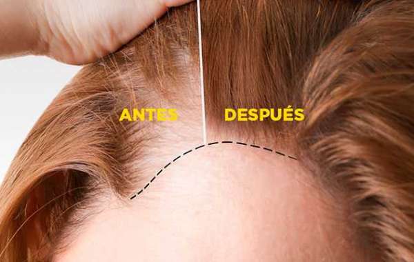 Plasma Rico en Plaquetas Para El Cabello