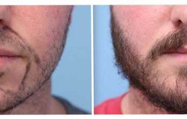 Beard Transplant Near Me