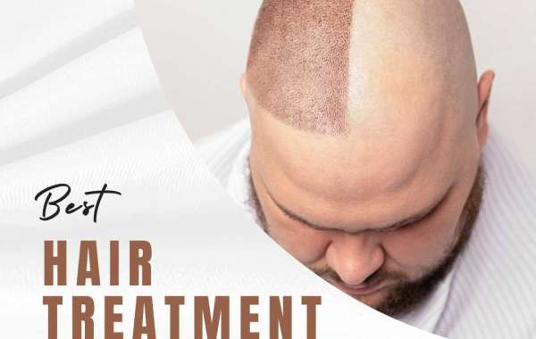 Revitalize Your Look: Hair Transplant Solutions in Christchurch