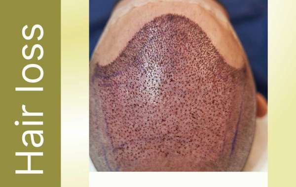 Regain Your Confidence: Combat Hair Loss in Christchurch