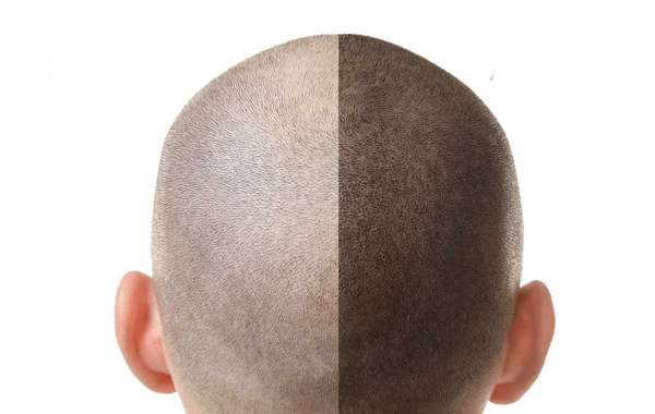 Finding the Perfect Fit: Top Hair Specialists in New Delhi
