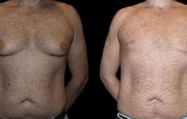 Living an Active Life After Male Breast Reduction in Dubai