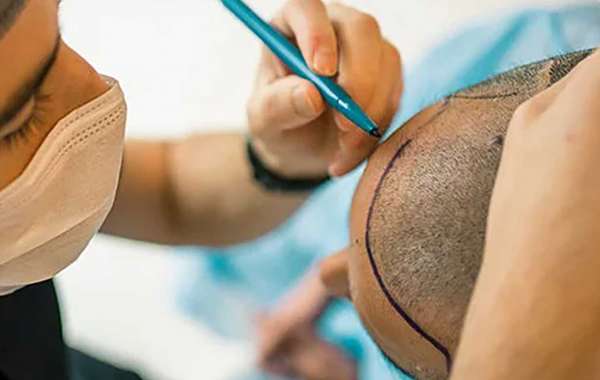 Best Hair Transplant Surgeons Near You