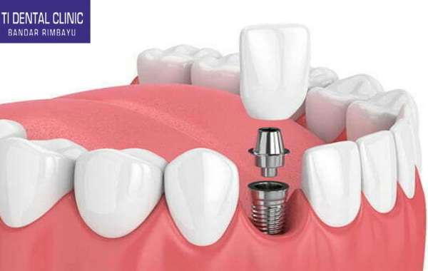 Children's Braces: What Parents Need to Know at Tidental