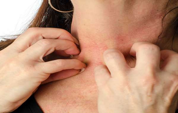 From Symptoms to Treatment: Delhi’s Best Tips for Skin Allergy Management