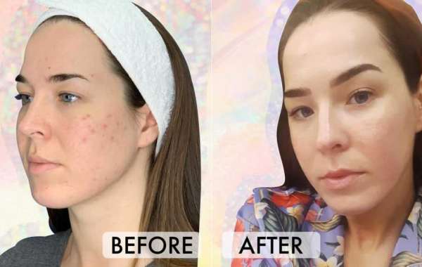 All About the Vampire Facial: Essential Information and Insights
