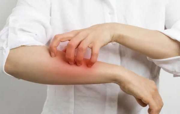Expert Skin Allergy Treatment in Delhi for Long-Lasting Relief