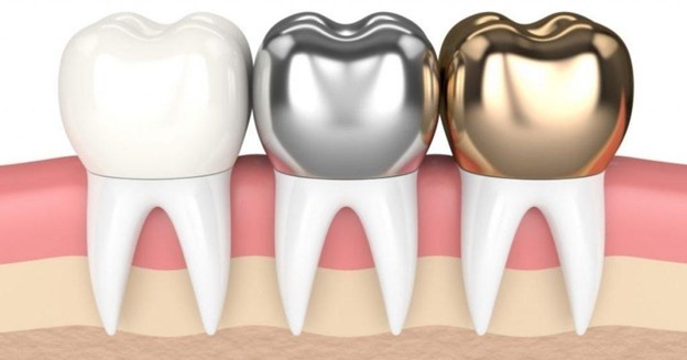 Types of Dental Crowns | Benefits and Step-by-Step Procedure
