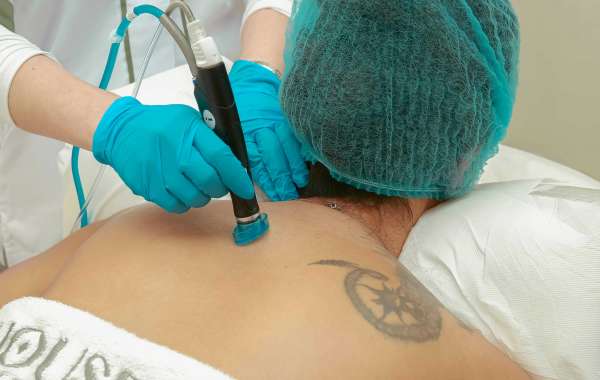The True Cost of Tattoo Removal in Pune – Is It Worth It?