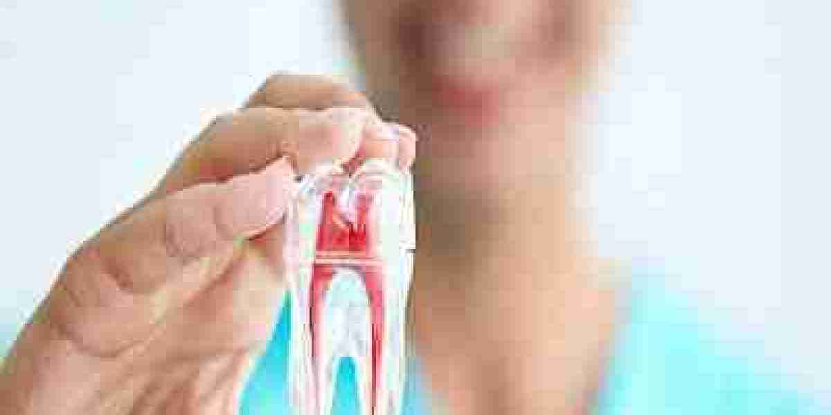 Signs You Might Need a Root Canal Treatment