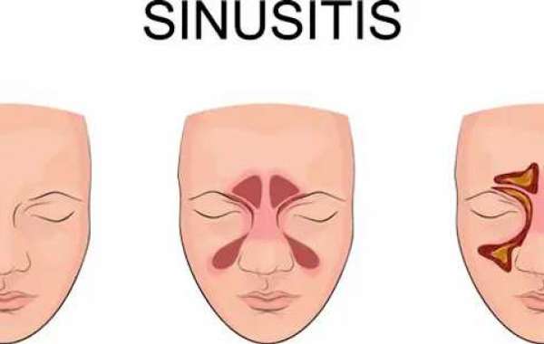 Breathe Easy Again with Sinusitis Care at Veekay Clinic, the Best ENT Clinic in Vasant Kunj
