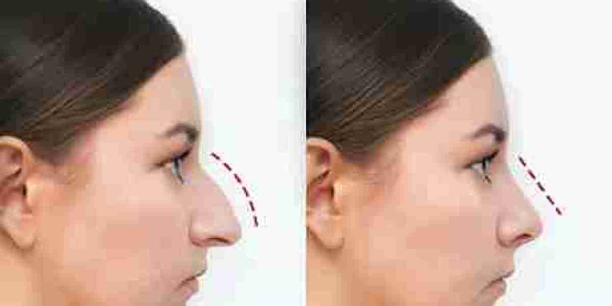 Transform Your Nose with Expert Rhinoplasty at Veekay Clinic, Gurgaon