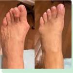 Plantar Fasciitis South Amboy