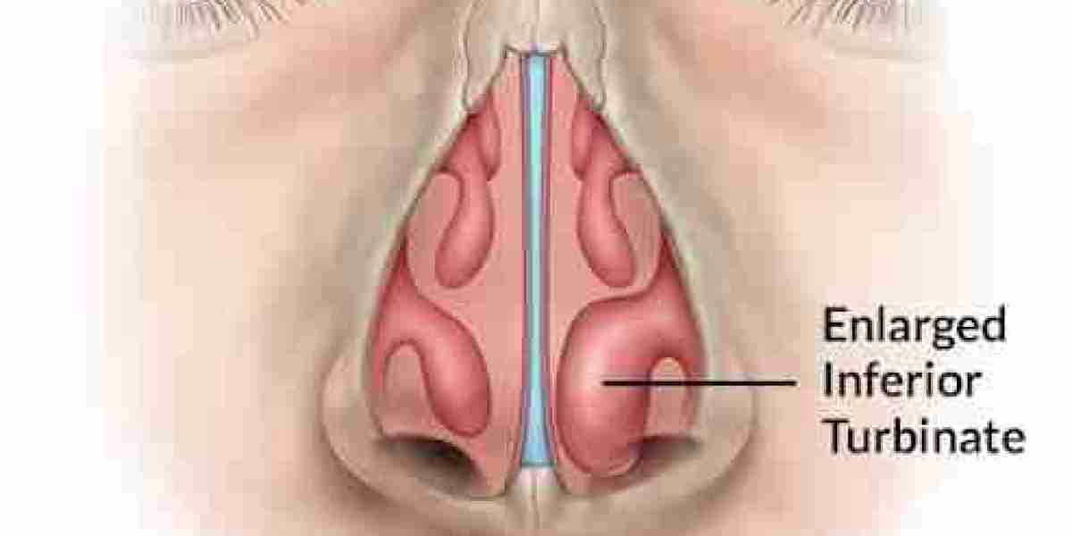 Turbinoplasty Treatment by Top ENT Clinic in Vasant Kunj