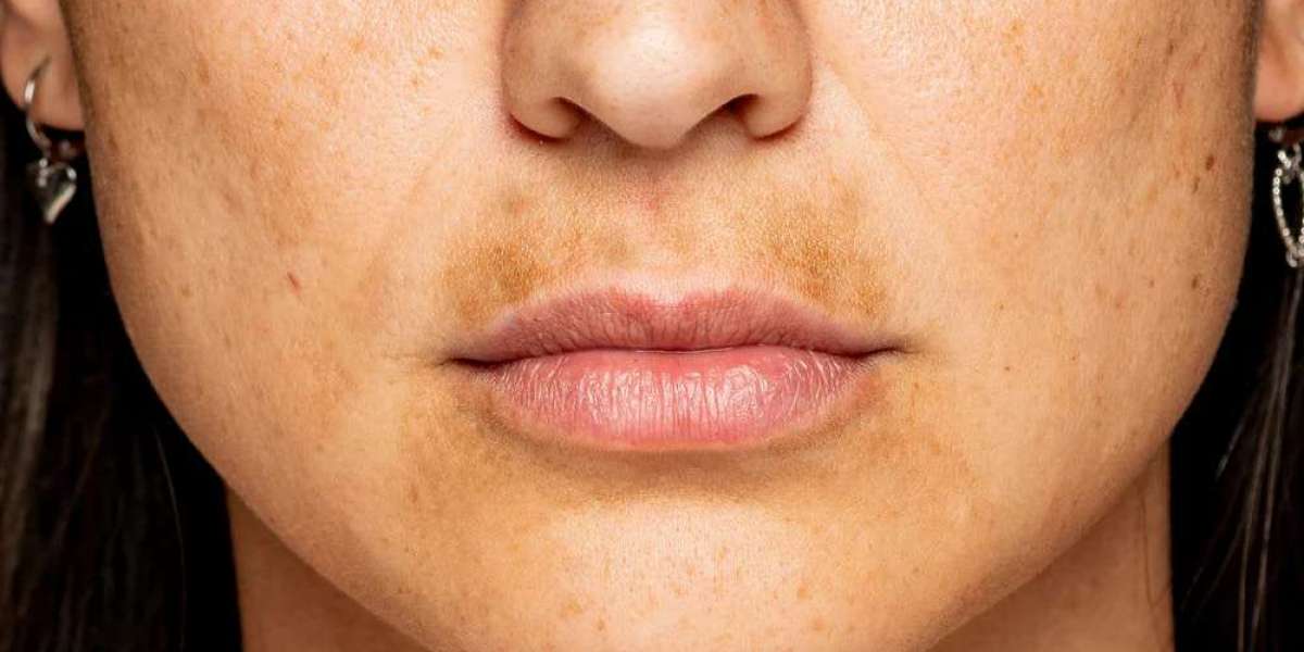 Hyperpigmentation: Causes, Types, and How to Treat Uneven Skin Tone