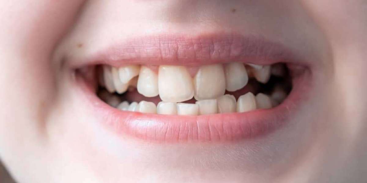 Ready to Fix Your Overlapping Smile? Start Today
