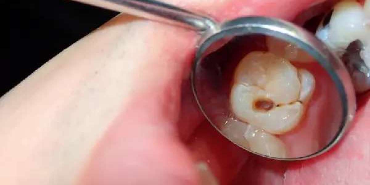 Do All Four Wisdom Teeth Get Pulled at Once?