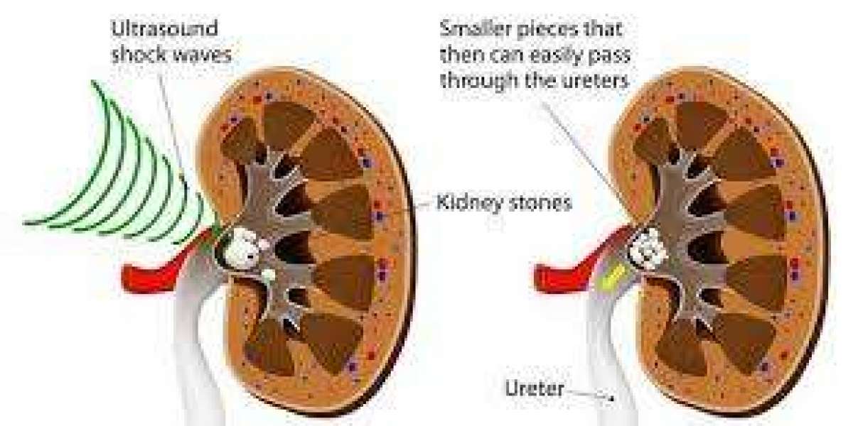 A Complete Guide to Choosing the Right Kidney Stone Hospital and Treatment
