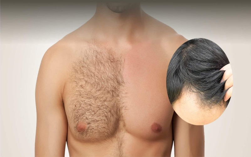 Body Hair Transplant - Winsome