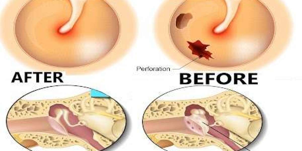 Get Relief from Eardrum Perforation – Trusted Tympanoplasty at Veekay Clinic