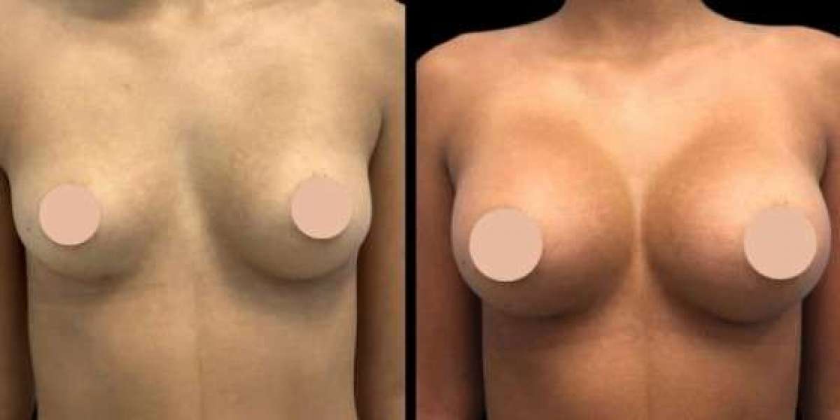 Flawless Results by the Best Breast Augmentation Surgeons in Dubai