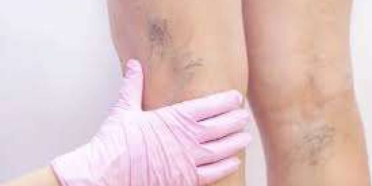 How to Find the Right Vascular Surgeon in Pune for Your Condition