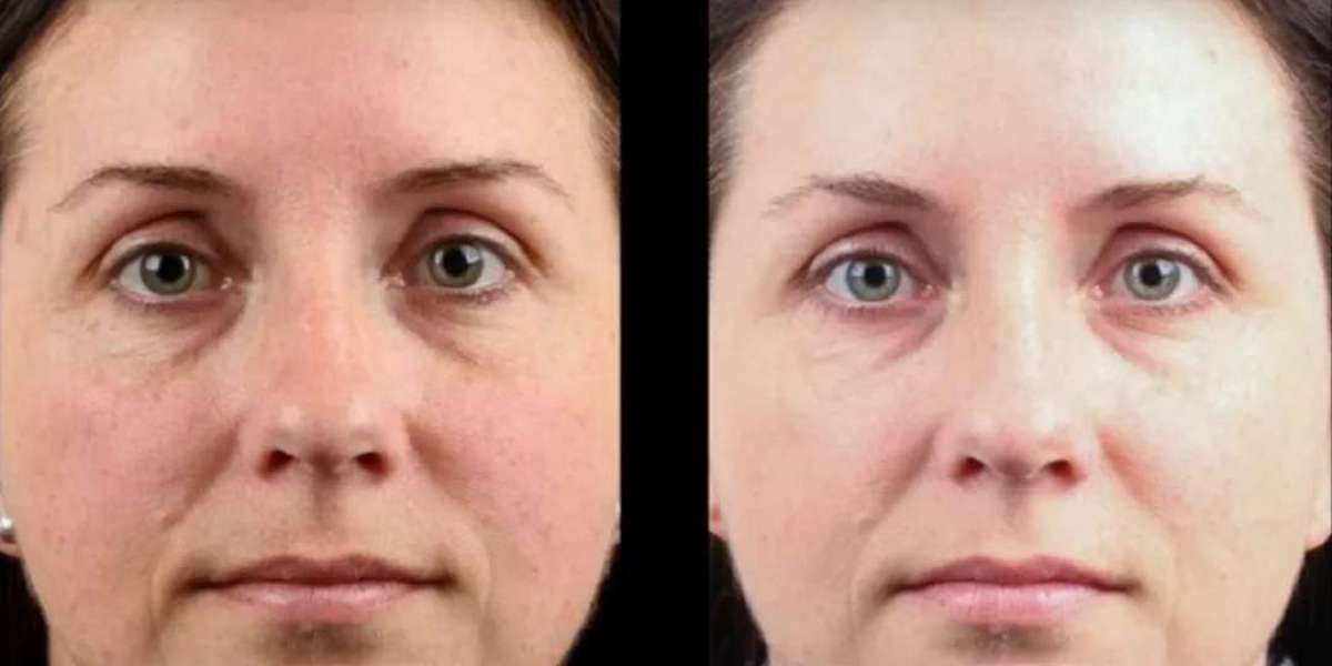 What Kind of Freckles Respond Best to Treatment in Dubai?