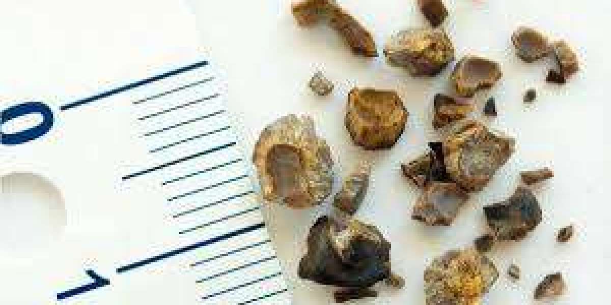 Non-Surgical Kidney Stones Treatment: A Safer Path to Recovery