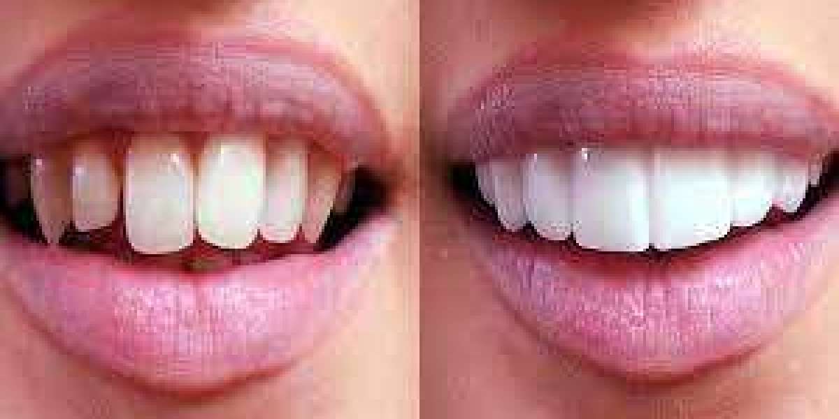 Temporary vs. Permanent Veneers: What’s the Difference?