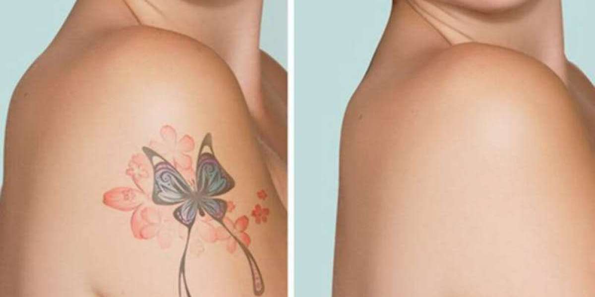 How Much Does Laser Tattoo Removal Cost in Dubai for Large Tattoos?