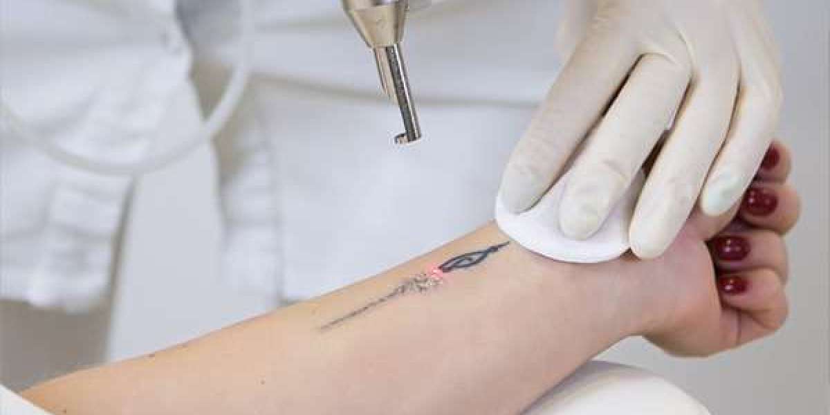 Laser Tattoo Removal – Safe & Effective Ink Removal