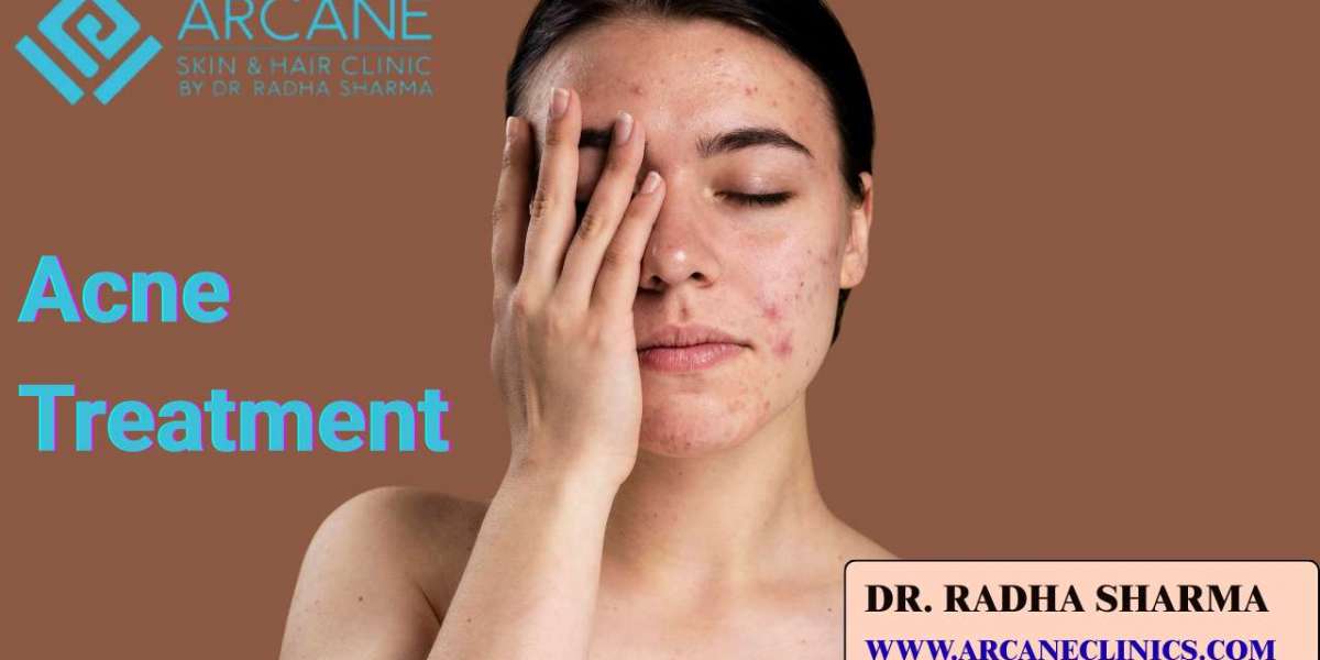 Types, Causes and Treatments for Acne Treatment