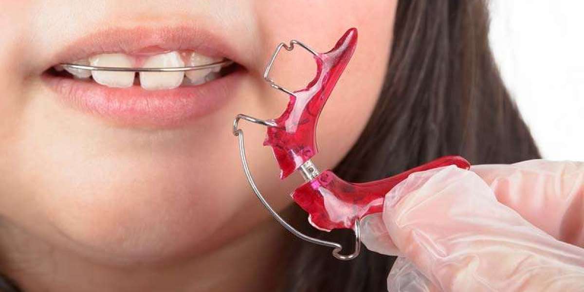 Retainers for Kids: When and Why They’re Needed