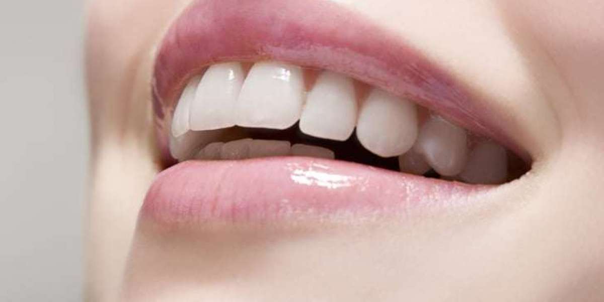 What Should I Avoid After Whitening My Teeth?