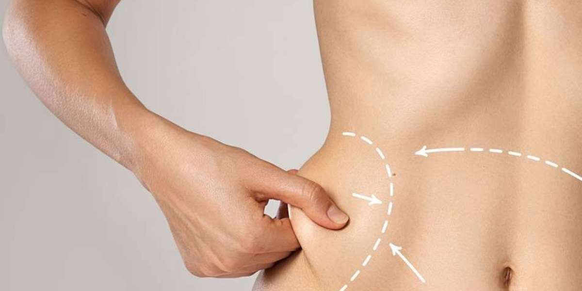 Pain Management After Liposuction in Islamabad