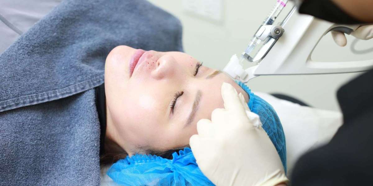 Mesotherapy Injections vs. Hair Transplants: Which Wins?