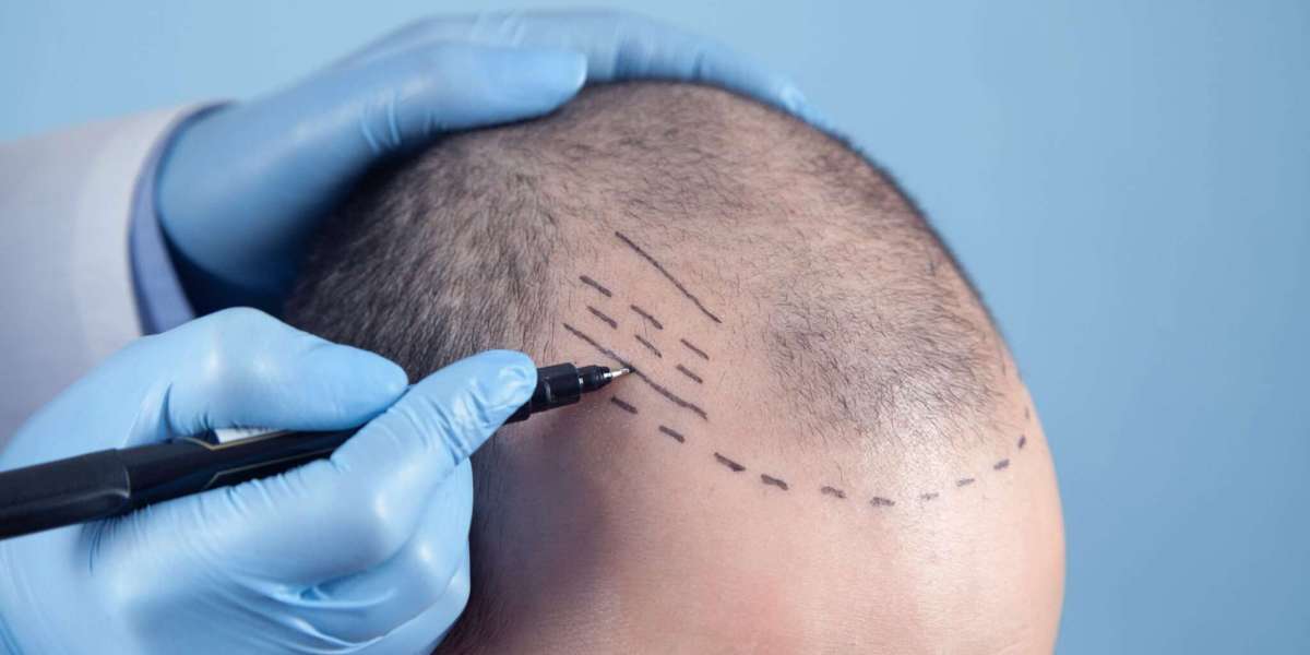 How to Know If You’re Ready for a Crown Transplant