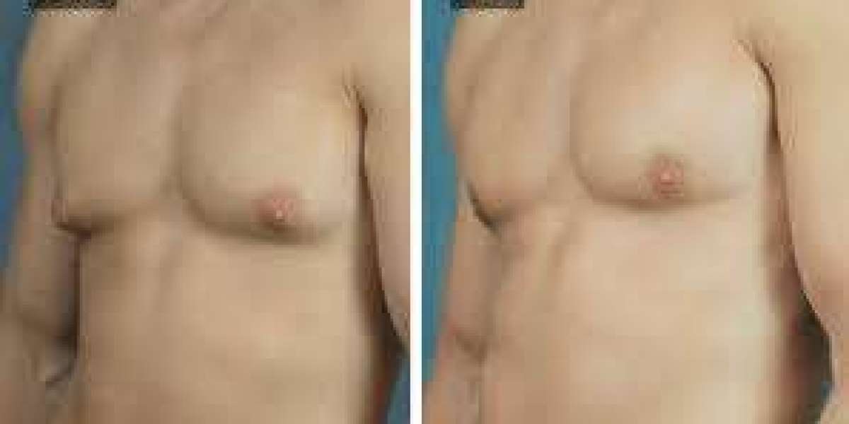 Understanding Gynecomastia Signs and Symptoms & Effective Arm Fat Reduction for Women