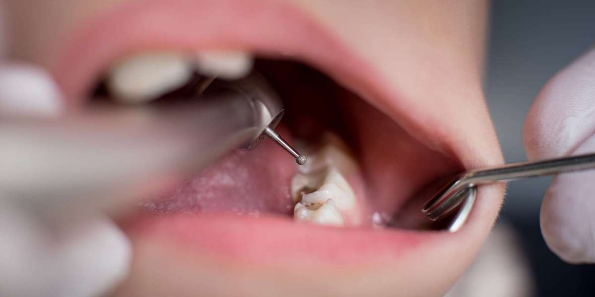 Does repeated filling cause nerve damage?