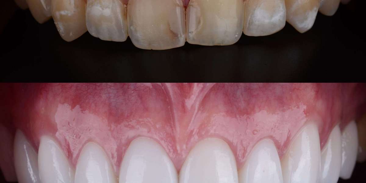 Teeth Whitening After Oral Surgery: When Is It Safe?
