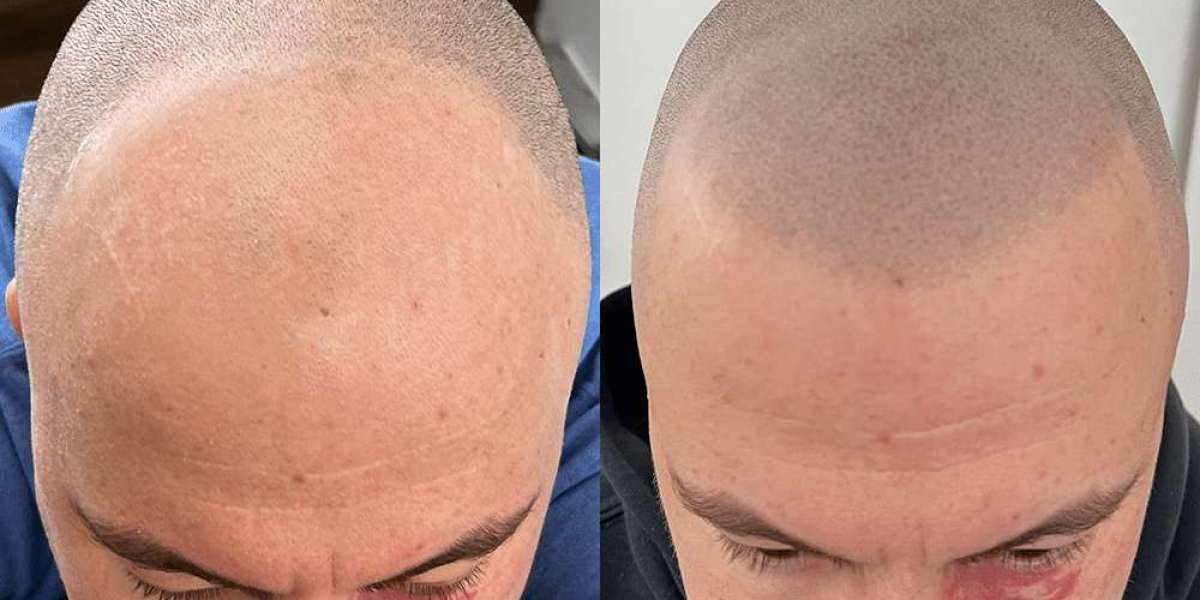 Does SMP Look Good as You Age?
