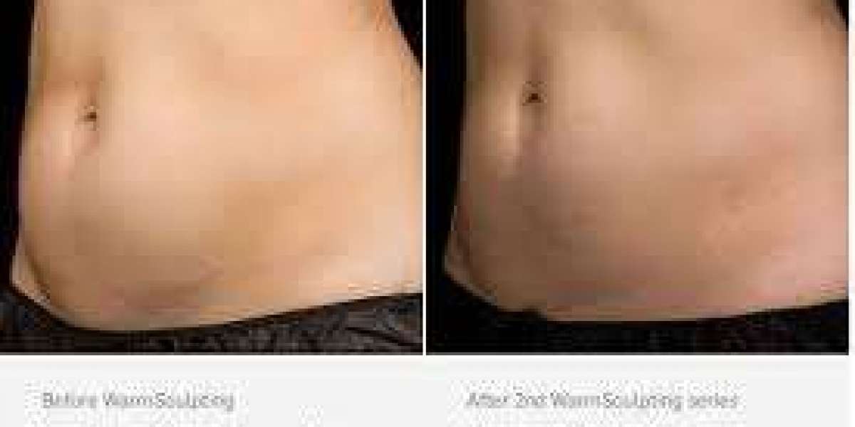 Achieve a Sculpted Body with U Lipo Treatment and Non Surgical Liposuction