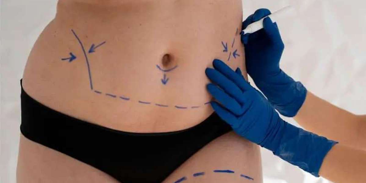 Can I Travel Soon After Liposuction in Dubai Without Complications?