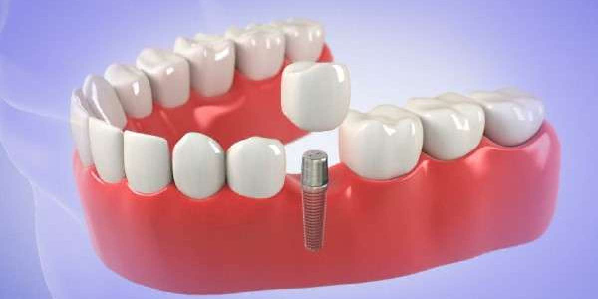 How to Care for Your Dental Implants: Tips and Tricks