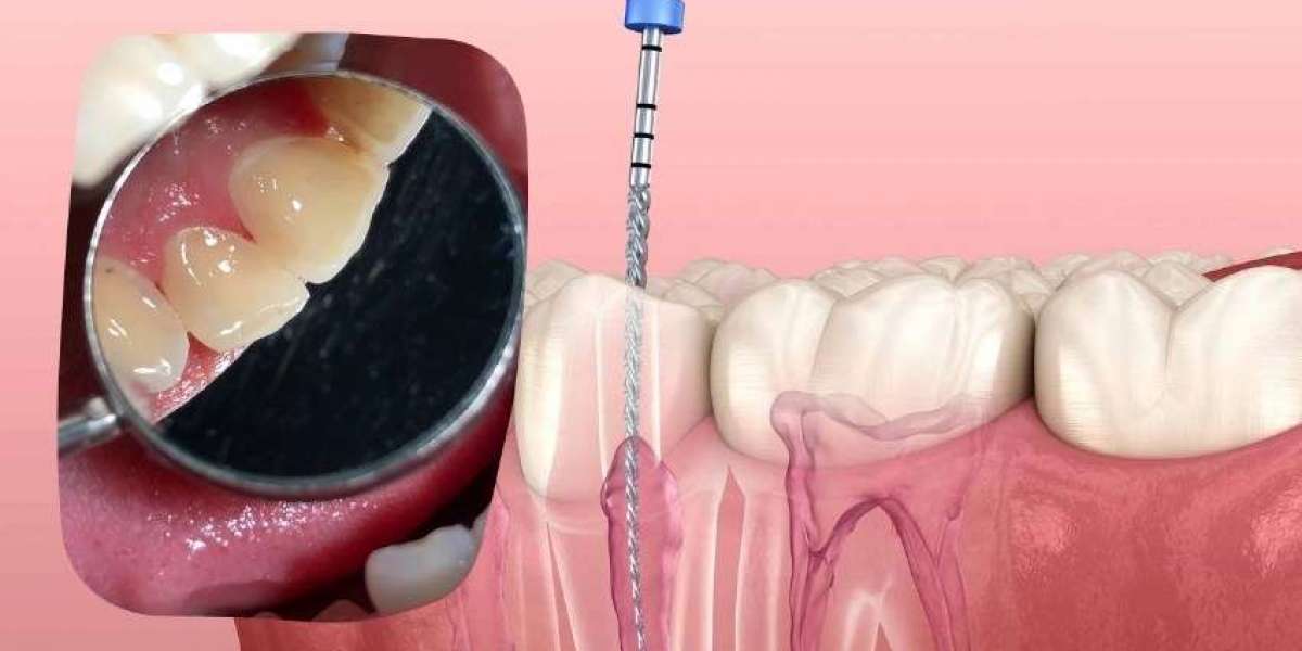 Root Canal Treatment in One Visit: Is It Possible