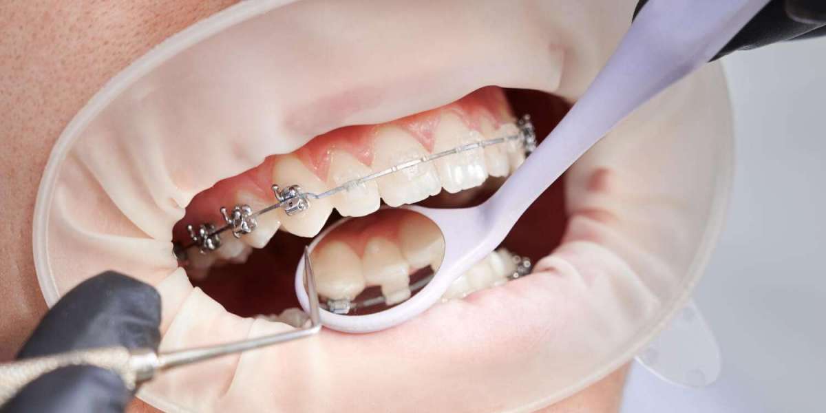 How to Manage Discomfort During Your Metal Braces Journey