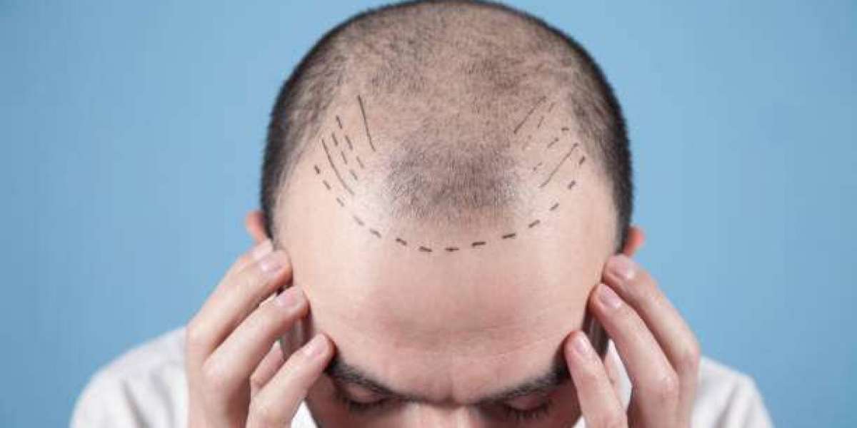 Best Hair Transplant Clinics in Riyadh | Get a Free Quote Today